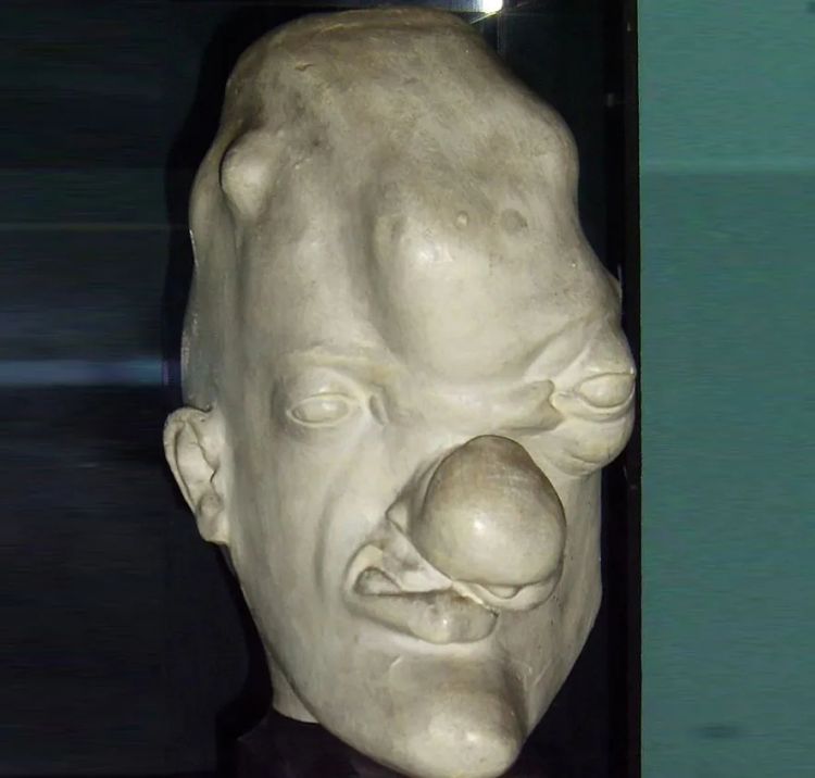 日本飙升的梅毒，到底是什么毒？